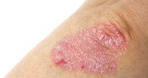 pacientes con psoriasis
