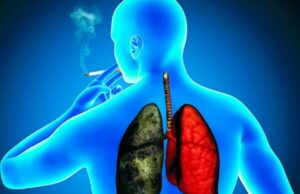 cáncer de pulmón