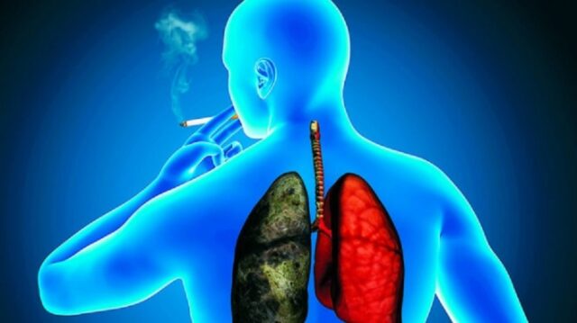 Cancer de Pulmón. 1 cáncer de pulmón