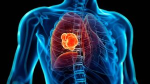 cáncer de pulmón