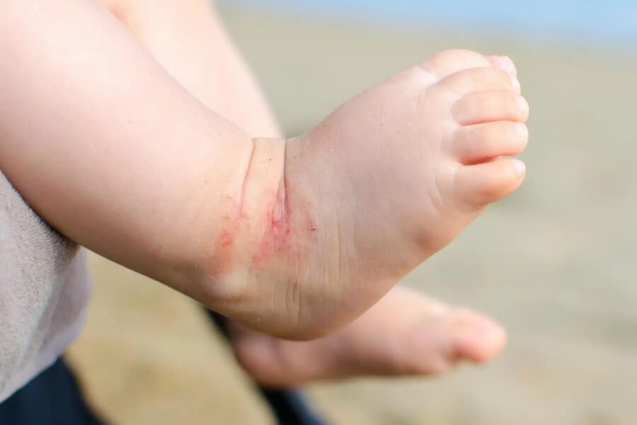 Más de un 50% de los niños que visitan especialistas de la piel van por una dermatitis atópica dermatitis atópica