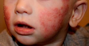 dermatitis atópica