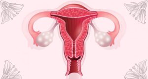 Cáncer de Ovarios